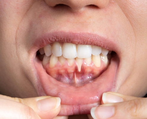 Gum disease treatment in Tampa FL