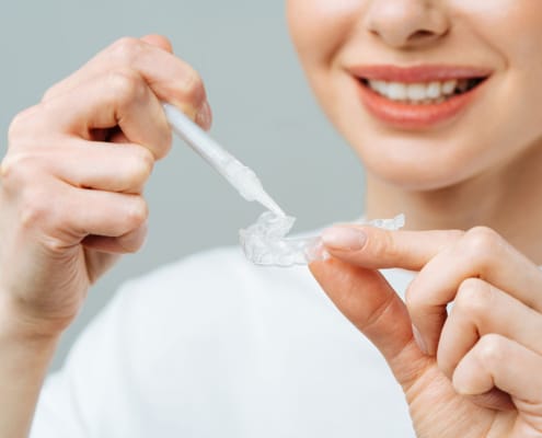 Invisalign candidate consultation Tampa