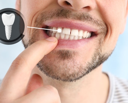 Dental implants complete guide Tampa