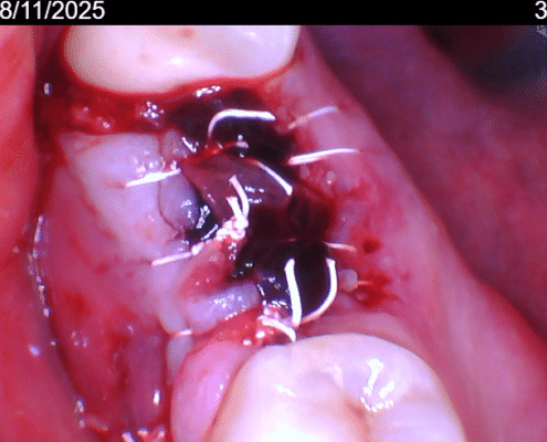 Regenerative Dentistry Tampa