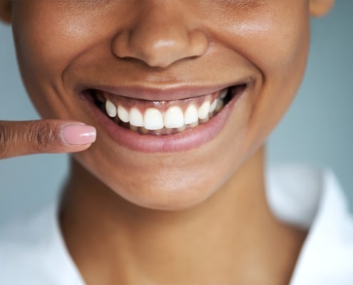 About dental veneers