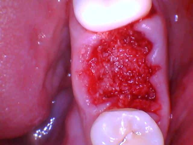 Regenerative dentistry in Tampa, FL