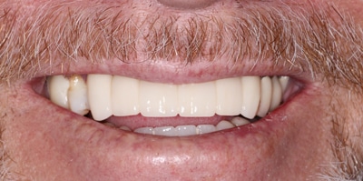 After – Full Mouth Rehabilitation