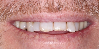 Before – Full Mouth Rehabilitation