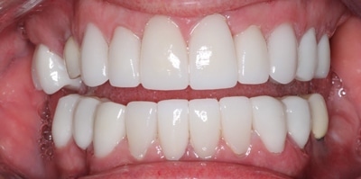 After – Full Mouth Rehabilitation