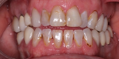 Before – Full Mouth Rehabilitation