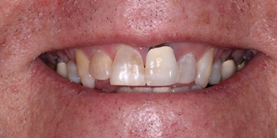 Before – Full Mouth Rehabilitation