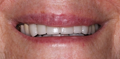 After – Crowns / Smile Makeover