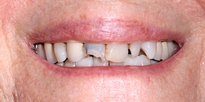 Before – Crowns / Smile Makeover