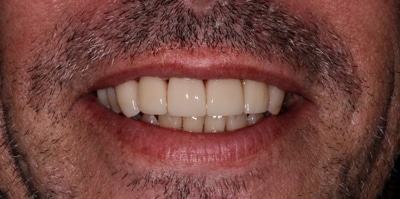 After – Crowns / Smile Makeover