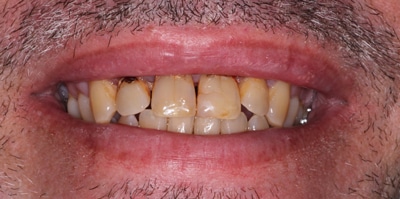 Before – Crowns / Smile Makeover