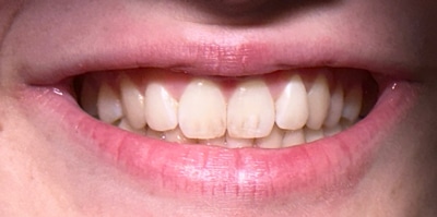 After – Gingivectomy