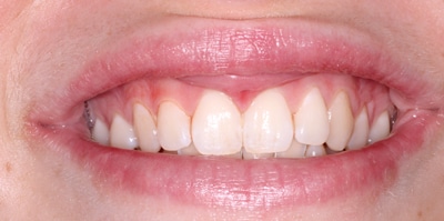 Before – Gingivectomy